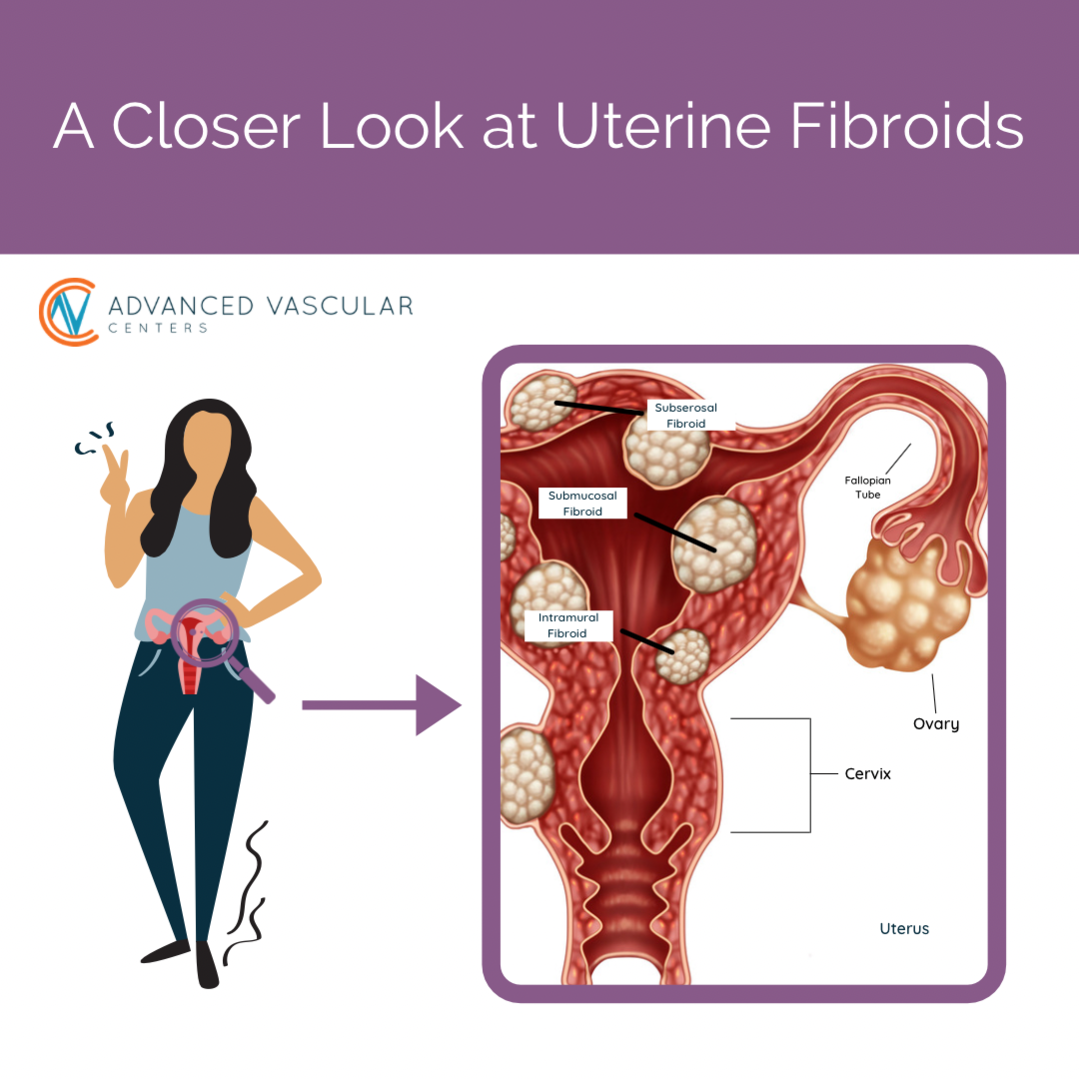 uterine fibroids images