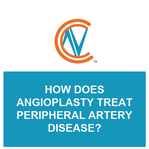 angioplasty