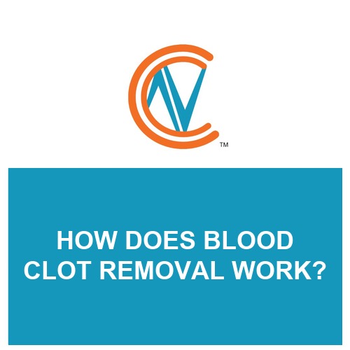 blood clot removal