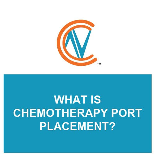 chemotherapy port placement
