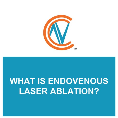 endovenous laser ablation