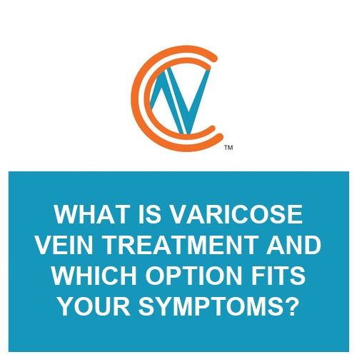 varicose vein treatment