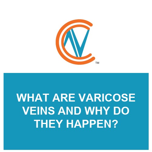 varicose veins